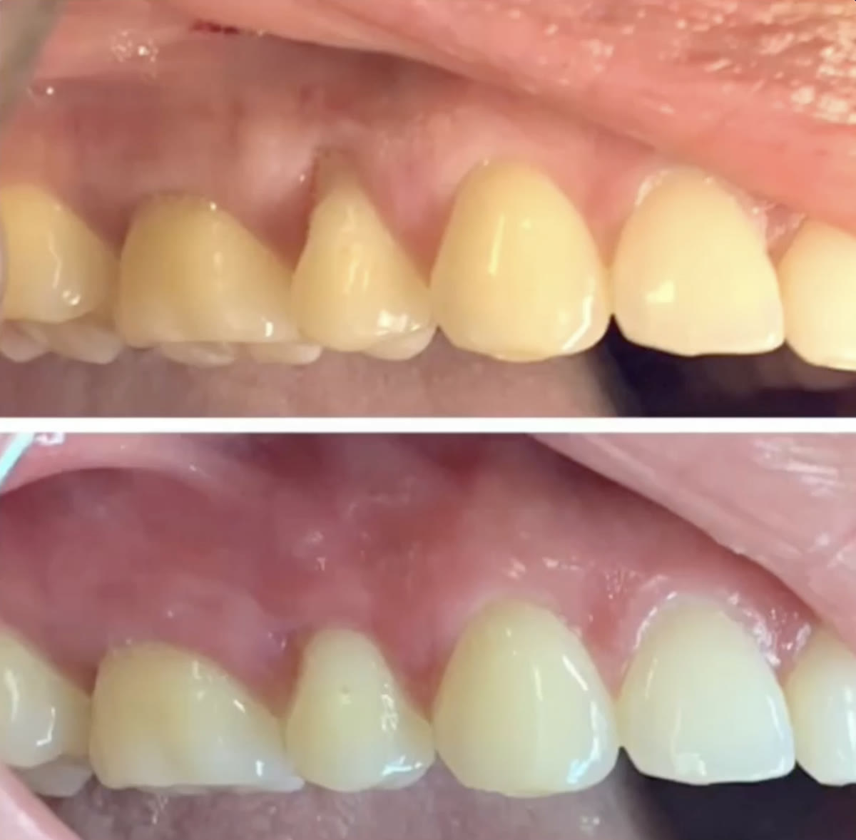 Gum contouring case treated by PPG, before and after