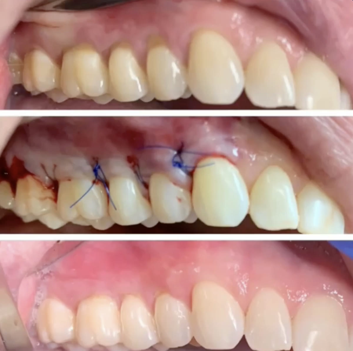 Graft site healing, treated by PPG
