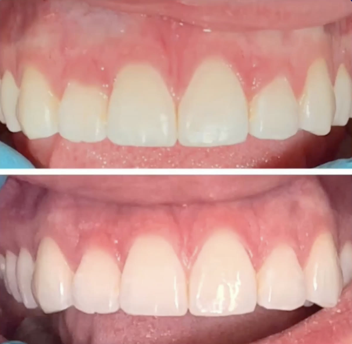 Gum grafting case treated by PPG, before and after