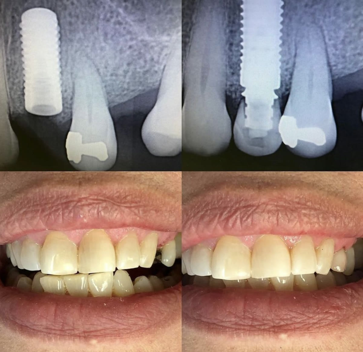 Dental implant case treated by PPG, before and after