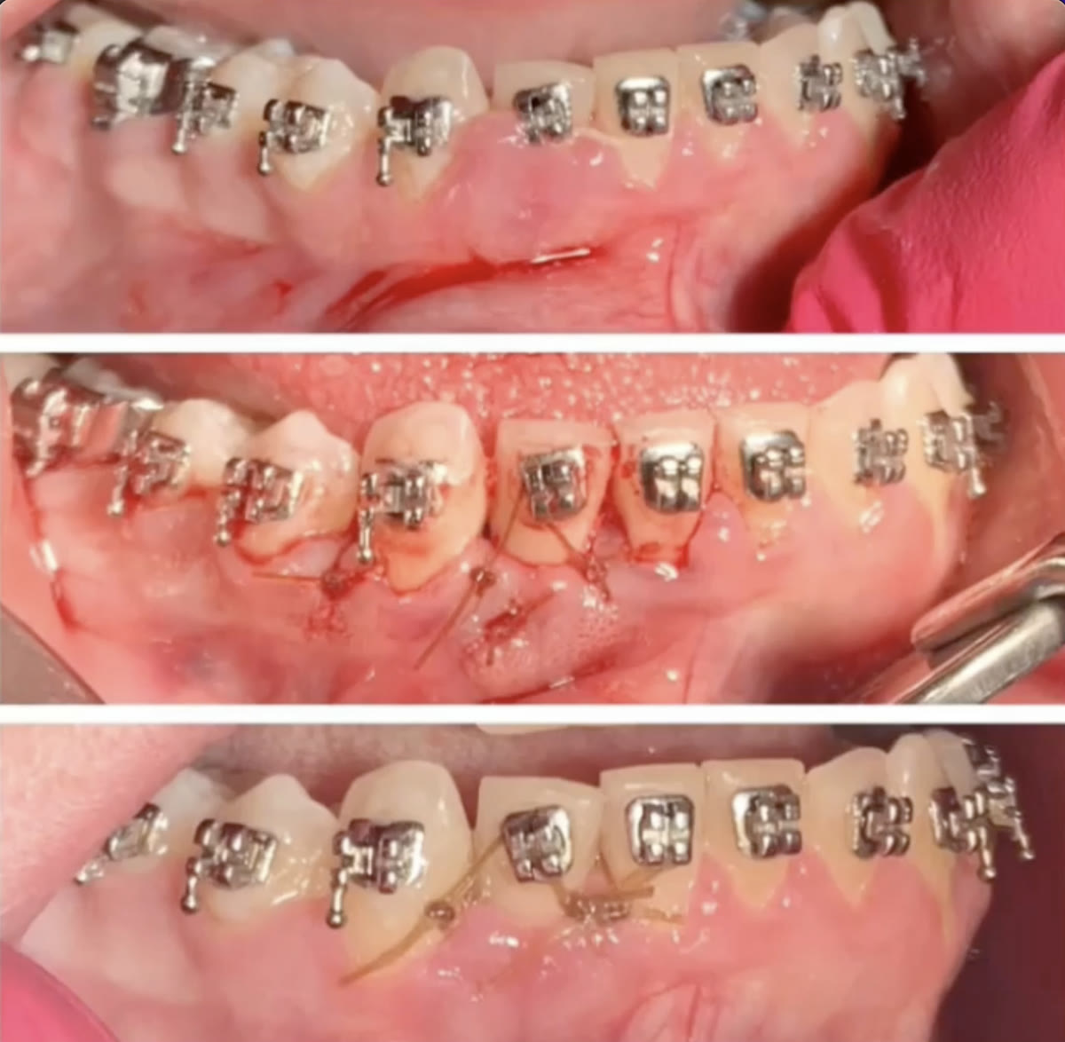 Combined orthodontic and periodontal case treated by PPG