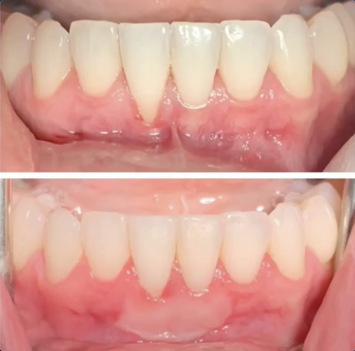 Gum recession case treated by PPG, before and after