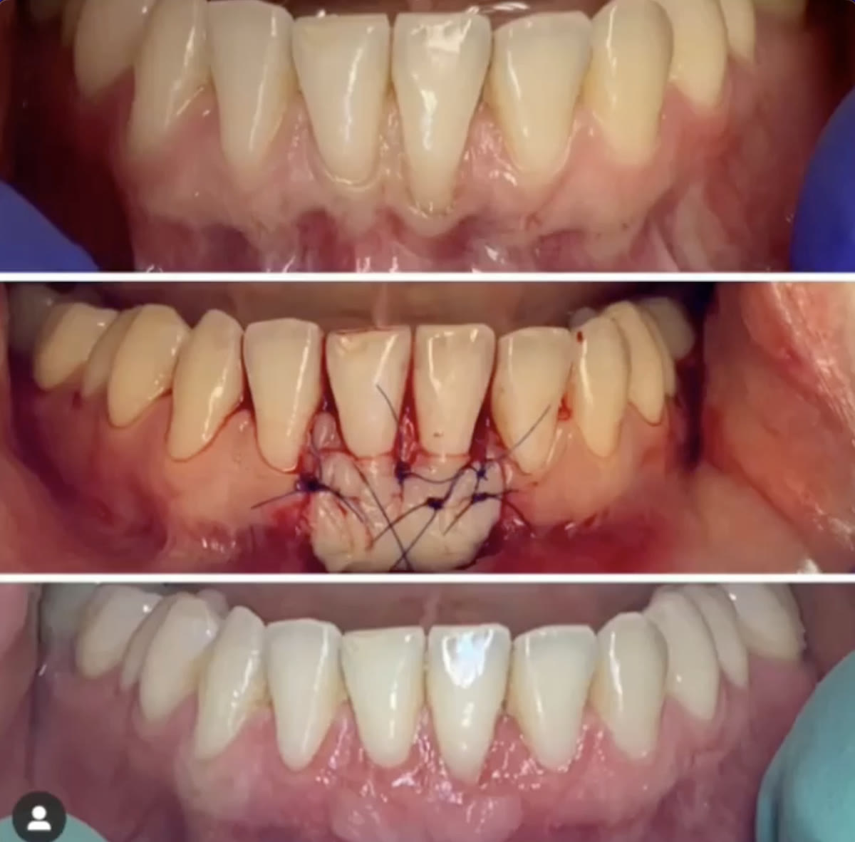 Periodontal surgery case treated by PPG, before and after